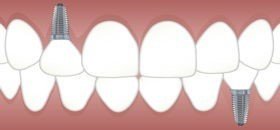 Diş Kliniği İmplant